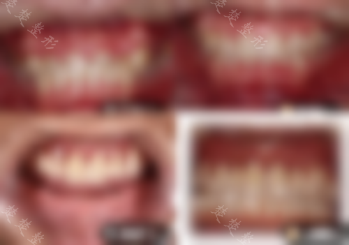 南昌安植雅口腔医院牙齿矫正和种植牙对比照