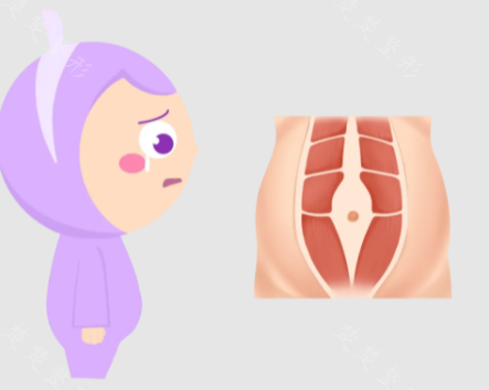 
分娩后盆底肌和腹直肌假体的区差异

