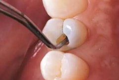 千万不要去补牙洞吗？为什么正规牙医不建议去补牙洞？