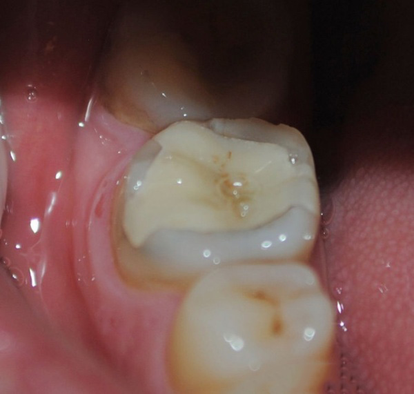 揭秘小诊所补牙便宜的原因，曝光小诊所补牙/全瓷牙/根管治疗